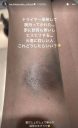 【女優】田中道子、「ドライヤー爆発」でやけど…黒ずんだ腕の写真公開　朝一病院へ　フォロワーのアドバイスに感謝